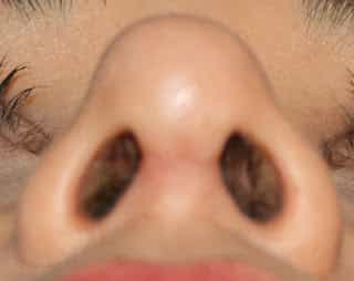 Cicatriz rinoplastia cirurgia plástica no nariz