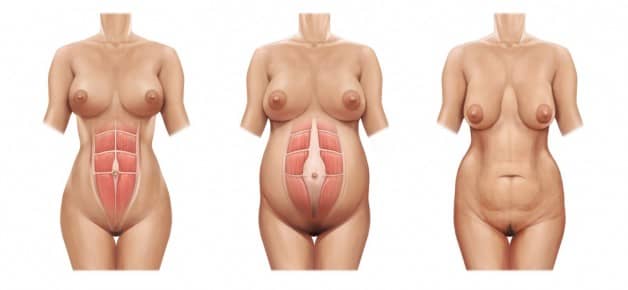 Mini-abdominoplastia e Abdominoplastia Abdome antes da gravidez, durante e após o parto