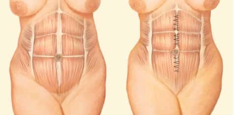 Mini-abdominoplastia e Abdominoplastia Musculatura aproximada por pontos