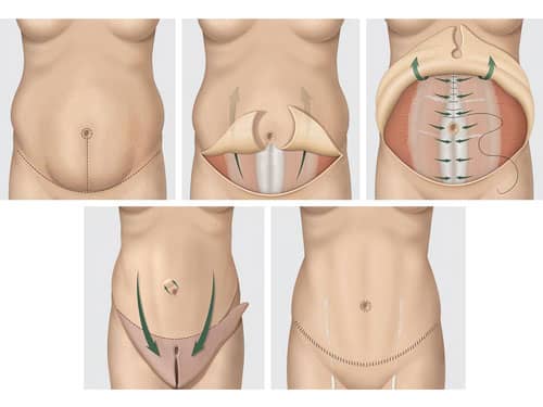 Mini-abdominoplastia e Abdominoplastia Retirada do excesso de pele