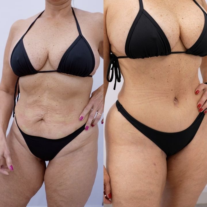 Antes e depois real de abdominoplastia com o Dr. Moises De Melo – resultado original, oficial e verídico de paciente da clínica