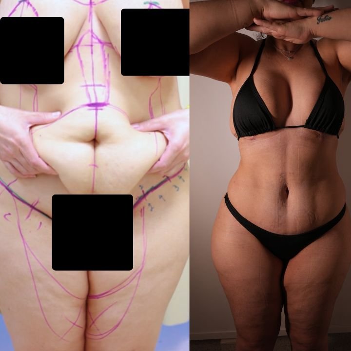 Antes e depois real de abdominoplastia com o Dr. Moises De Melo – resultado original, oficial e verídico de paciente da clínica