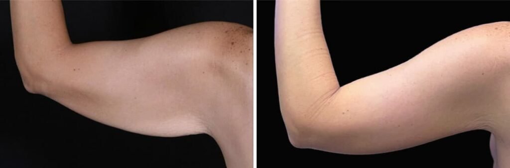 Antes e depois do Argoplasma no braço